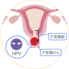 子宮頸(けい) がんの図
